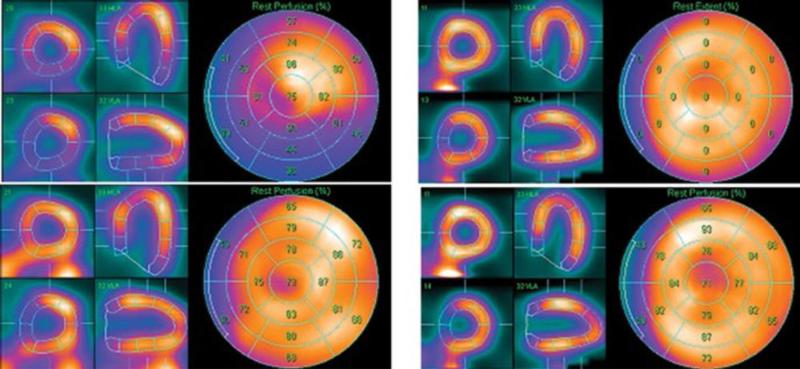 Сцинтиграфия миокарда. Однофотонная эмиссионная компьютерная томография миокарда. Однофотонная сцинтиграфия миокарда. ПЭТ ОФЭКТ миокарда. Перфузионная ОФЭКТ миокарда.